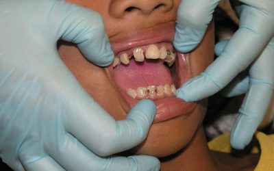 Rotten Teeth – The Most Common Dental Problem