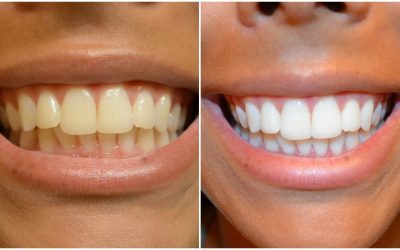 Are Whitening Strips Effective?