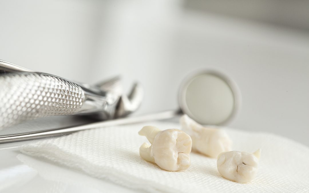 Prepare for Wisdom Teeth Removal Surgery