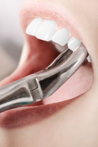 extraction vs root canal treatment