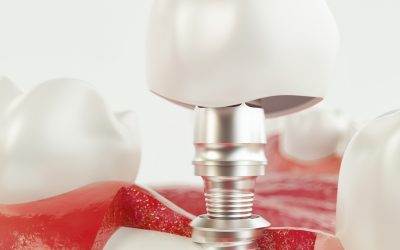 Implants after Bone Graft Healing Stages