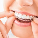 Invisalign Alternative