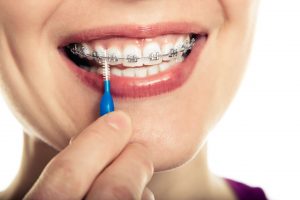 How To Brush Your Teeth With Braces