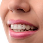 Invisalign Treatment Time