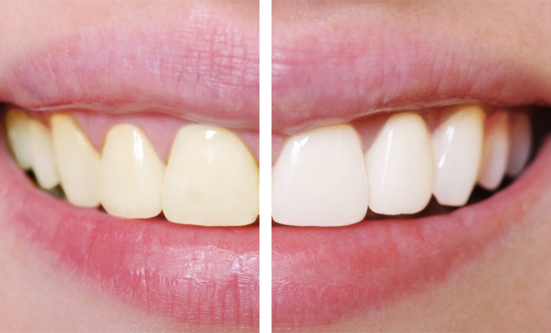 What Is The Average Cost of Teeth Whitening Services