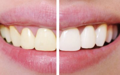 What Is The Average Cost of Teeth Whitening Services