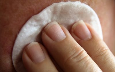 How to cure perioral dermatitis fast