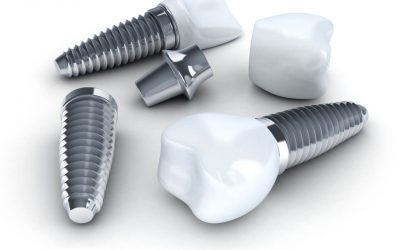 Learning about dental implants problems