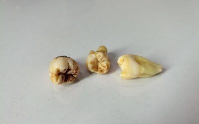 Best Prevention and Treatment for Rotten Tooth