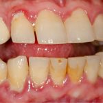 gingivitis stages