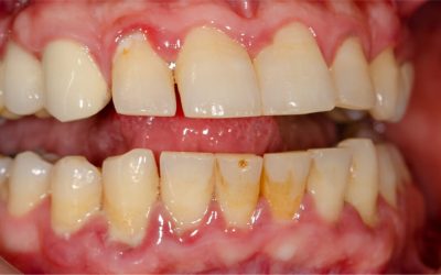 Gingivitis Stages and Care