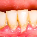 how to dissolve plaque on teeth