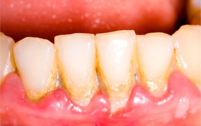 How to Dissolve Plaque on Teeth