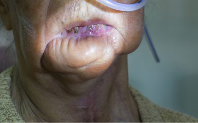Gum Flap Surgery
