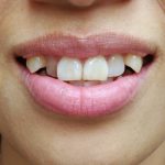 canine teeth human problems