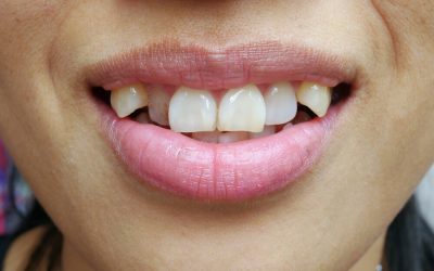 Canine Teeth Human Problems
