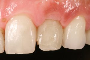 infection gum