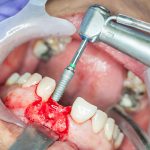 dental bone graft cost