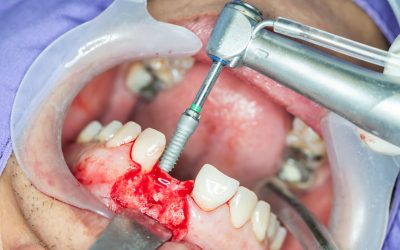 What’s the Cost for Dental Bone Graft?