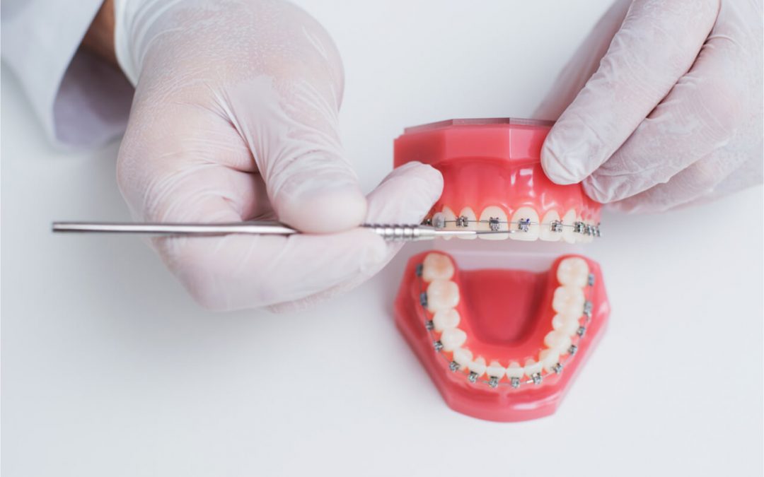 Invisalign vs Braces Which Is Faster?