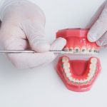 invisalign vs braces which is faster