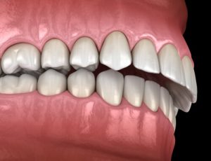 how to get rid of buck teeth