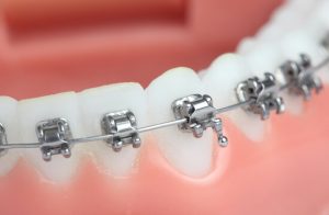 dental braces composition