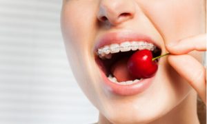 braces removable orthodontic appliances