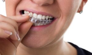 invisalign removable orthodontic appliances