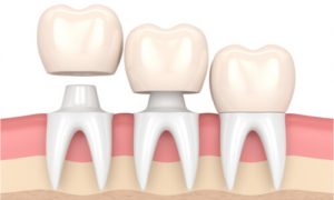illustration of tooth crowns