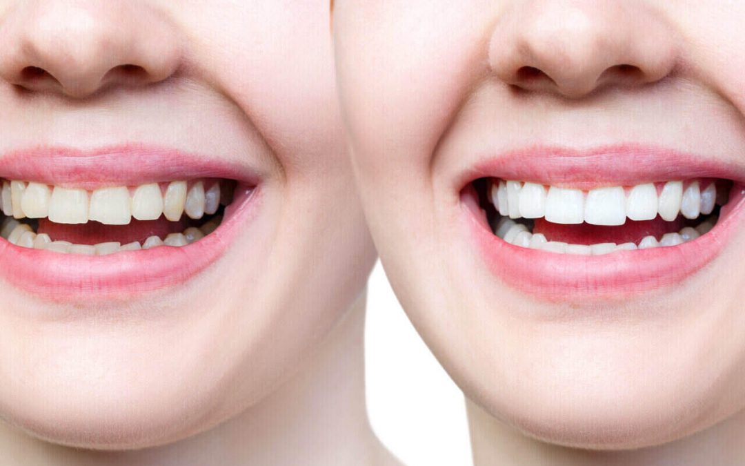 Chipped Tooth Repair: How Can A Dentist Help?