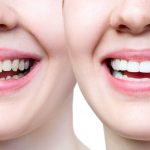 chipped tooth before and after repair