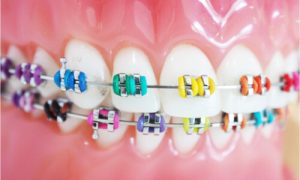 diferent brace colors