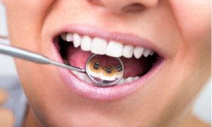 invisible braces teeth alignment options