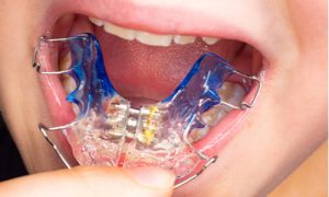overview of palate expander