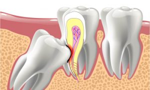 impacted wisdom tooth