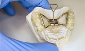 palate expanders use