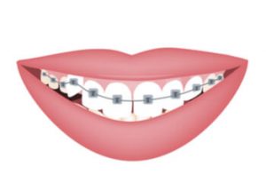 Orthodontic treatment