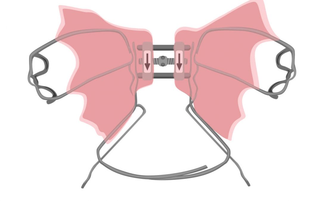 How to Clean Your Palate Expander