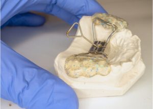 Palatal expander on stone cast