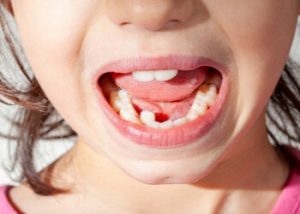 Palate expander for primary teeth