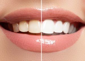 teeth whitening teeth whitening