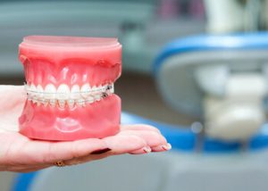 Adult braces vs kids braces