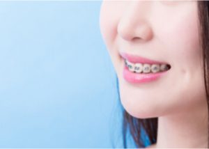 signs you need braces