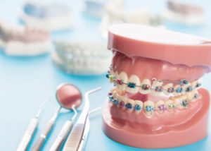 length of braces treatment(1)