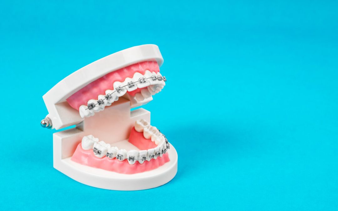 How to Get Braces for Your Teeth: A Comprehensive Guide