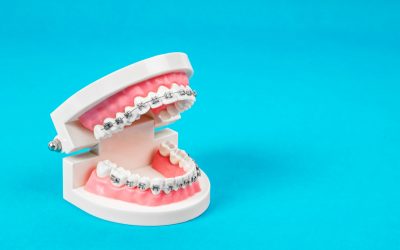 How to Get Braces for Your Teeth: A Comprehensive Guide