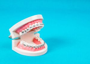 best age to get braces