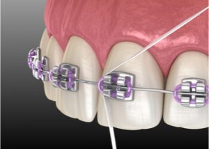 flossing with braces