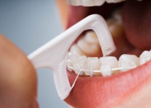 Flossing and dental health